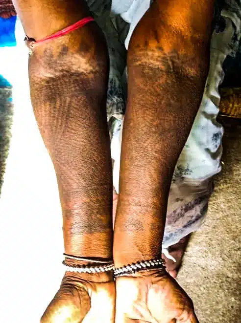 Tribal tattoo India - Santhal tribe tattoos